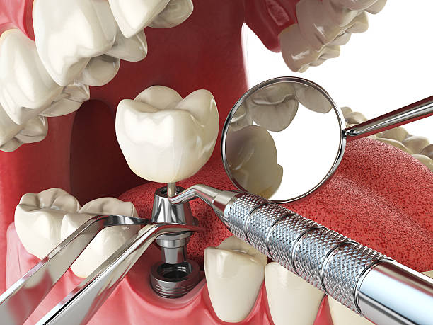 Best Emergency Root Canal Treatment in Lake Placid, NY